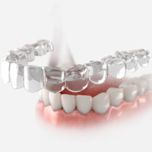 Bite for Life Subscription for Post Ortho Retainer Bi-Monthly